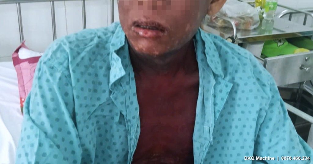 Tím tái, rộp loét toàn thân sau 3 lần nhỏ mắt: Ca hội chứng Lyell hiếm gặp và bài học an toàn thuốc